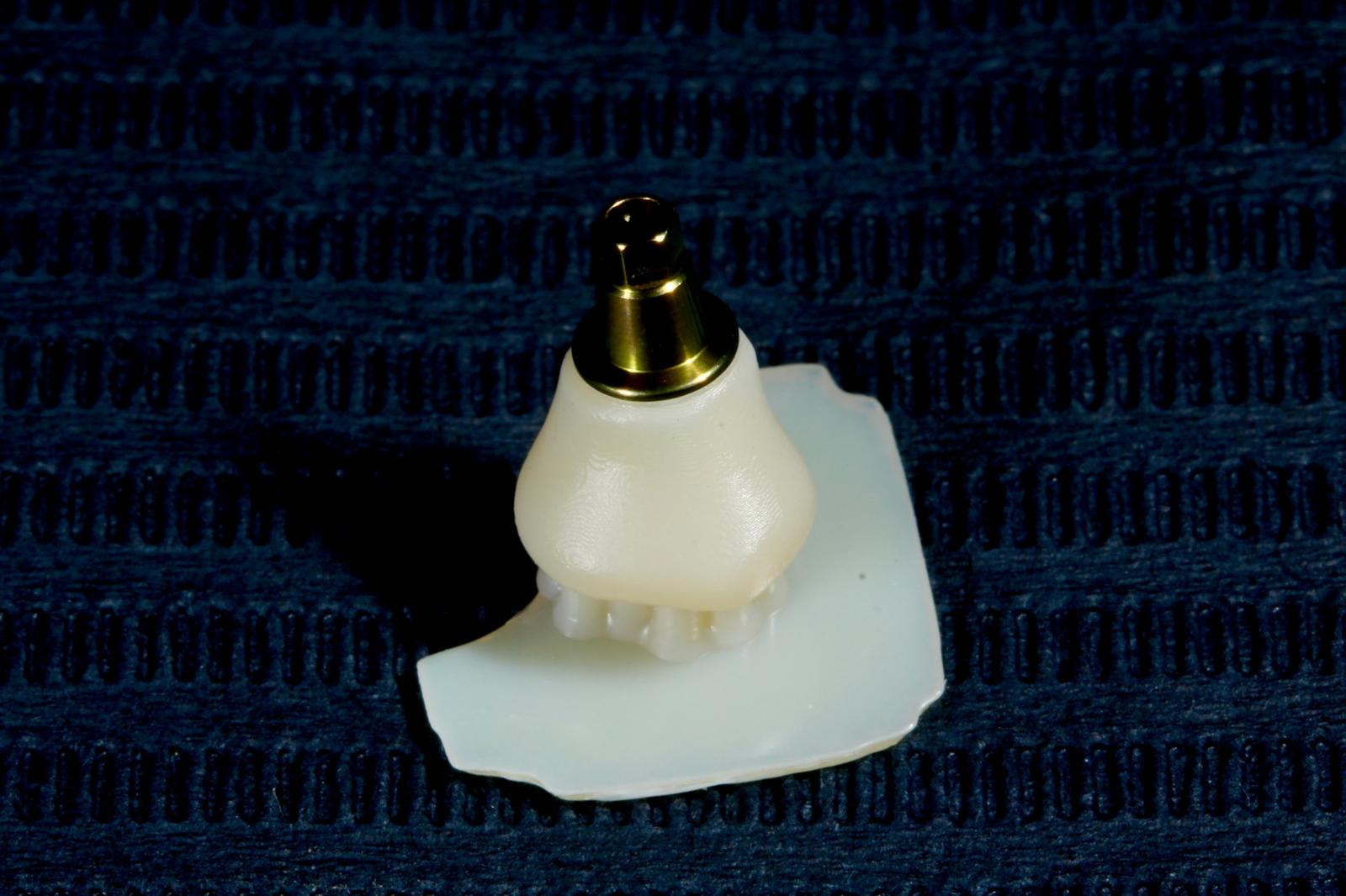 Férula dental impresa en 3D