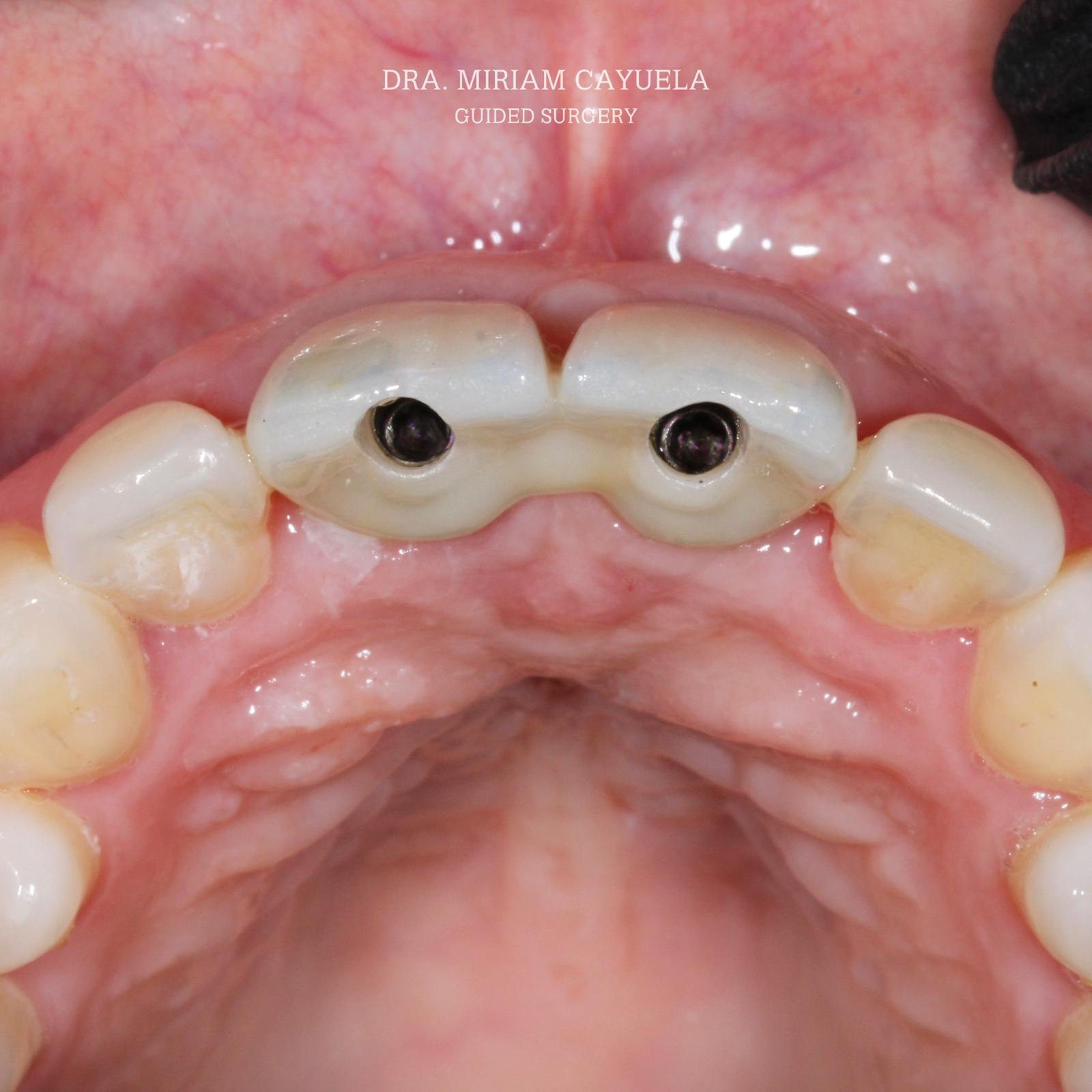 Provisionales sobre implante